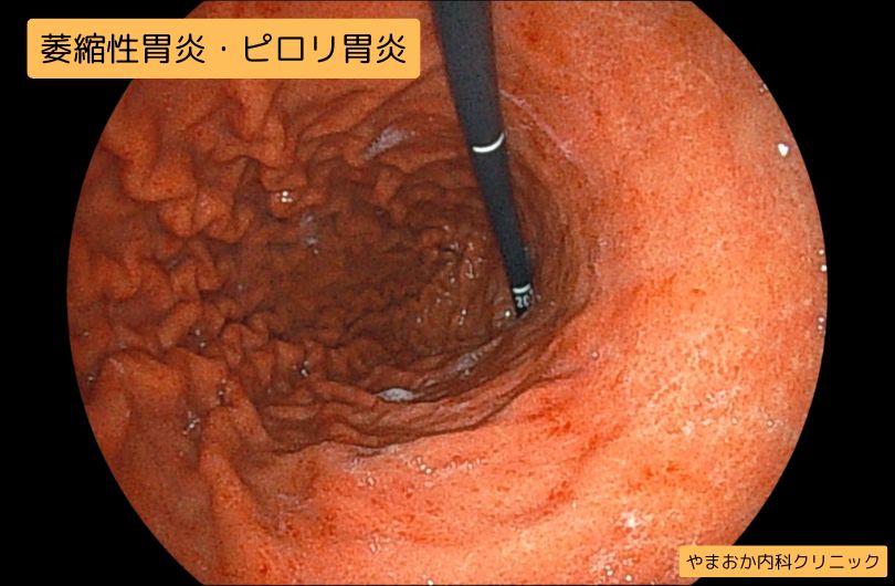 ピロリ菌のイメージ