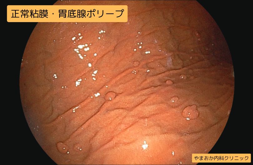 https://y-naika-clinic.com/wp-content/uploads/2025/04/正常粘膜・胃底腺ポリープ-1.jpg