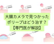 大腸カメラで見つかったポリープはどう治す？切除の種類と流れを専門医が解説
