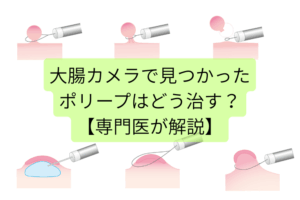 大腸カメラで見つかったポリープはどう治す？切除の種類と流れを専門医が解説