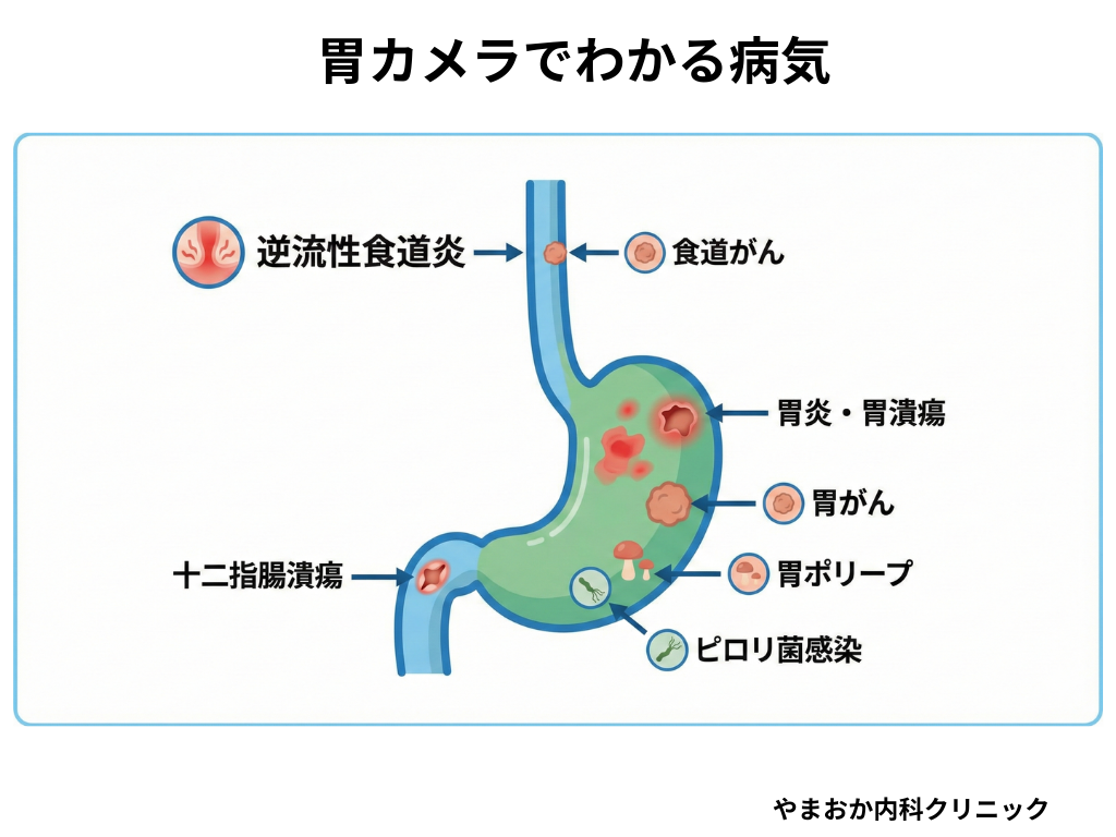胃カメラでわかる病気_大阪市平野区の胃カメラ_やまおか内科クリニック