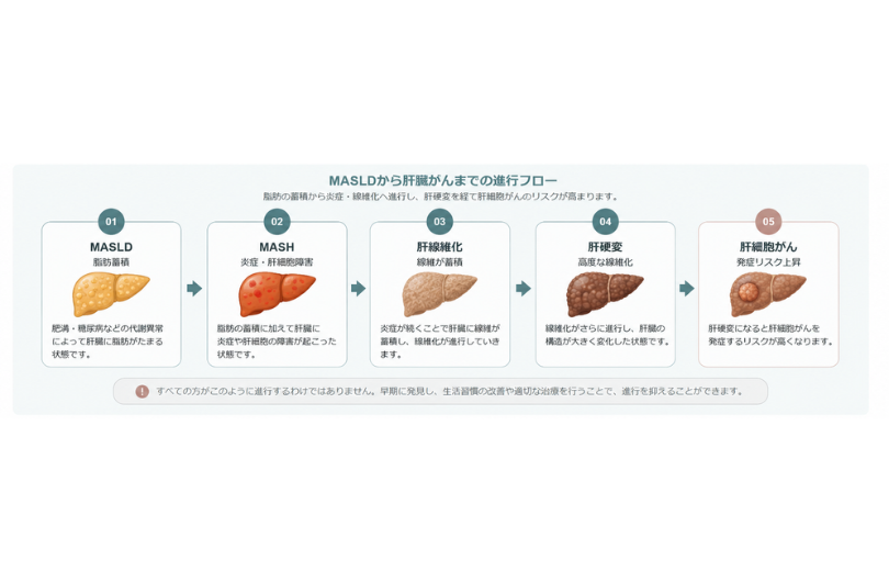 MASLDからMASH、肝線維化、肝硬変へ進行する流れ